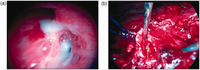 Right lower lobectomy following inhalation of a toy traffic cone.