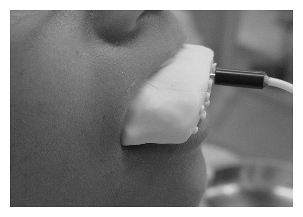 Laser Doppler Blood-Flow Signals from Human Teeth during an Alignment and Leveling Movement Using a Superelastic Archwire.