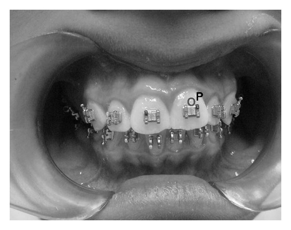 Laser Doppler Blood-Flow Signals from Human Teeth during an Alignment and Leveling Movement Using a Superelastic Archwire.