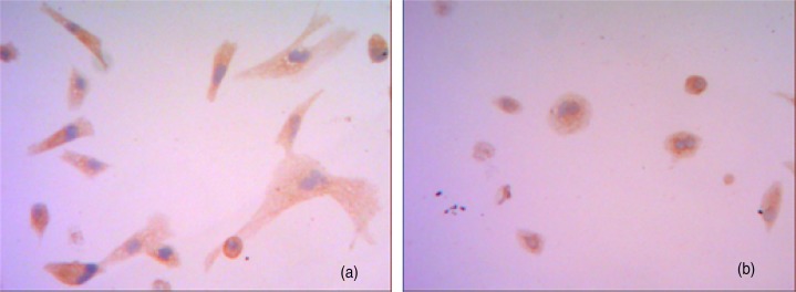 In vitro neuraotropic growth of cholangiocarcinoma: an experimental study.