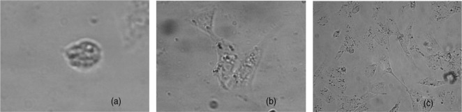 In vitro neuraotropic growth of cholangiocarcinoma: an experimental study.