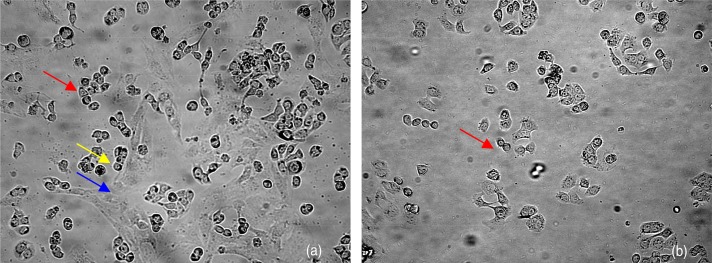 In vitro neuraotropic growth of cholangiocarcinoma: an experimental study.