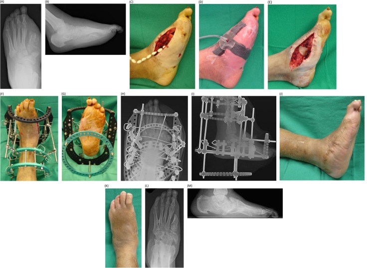 Negative-pressure wound therapy in the management of diabetic Charcot foot and ankle wounds.