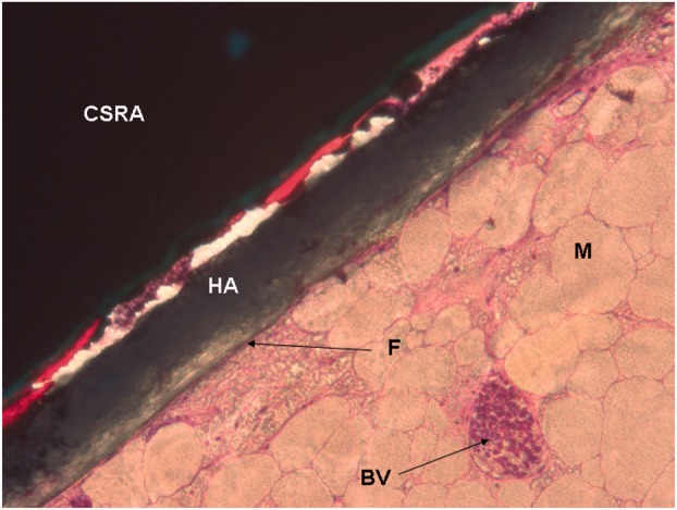 Histological evaluation of retrieved Copeland re-surfacing shoulder arthroplasties.