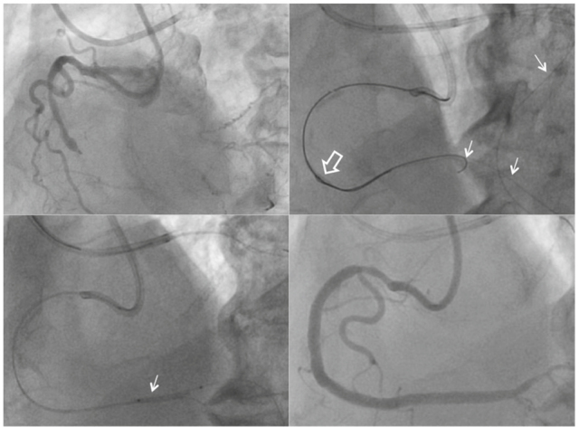 Opposition: Unfractionated heparin should no longer be used in the catheterization laboratory.