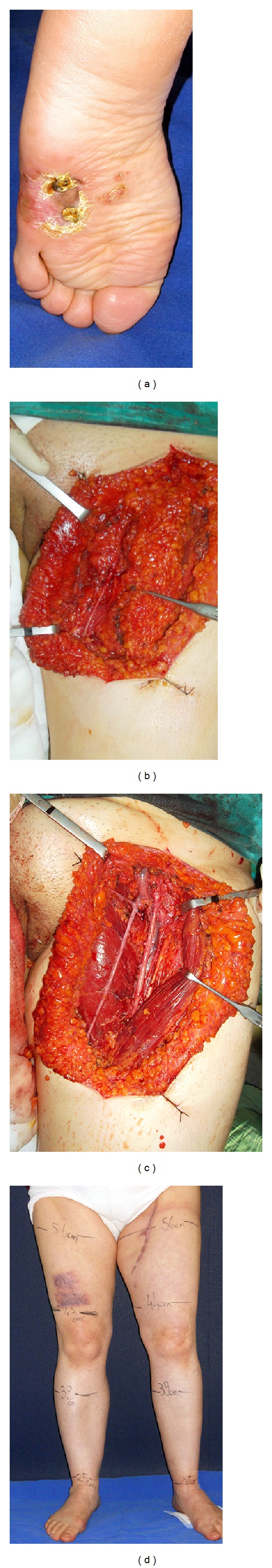 Saphenous vein sparing superficial inguinal dissection in lower extremity melanoma.