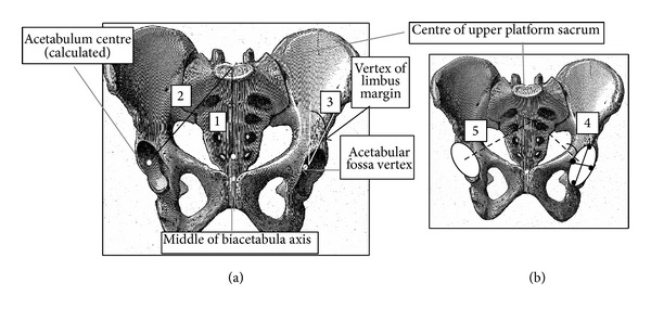 Pelvic incidence: a predictive factor for three-dimensional acetabular orientation-a preliminary study.