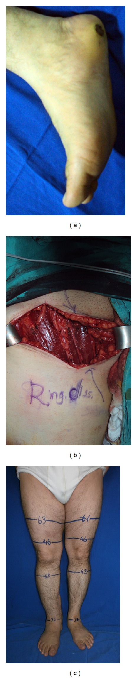 Saphenous vein sparing superficial inguinal dissection in lower extremity melanoma.