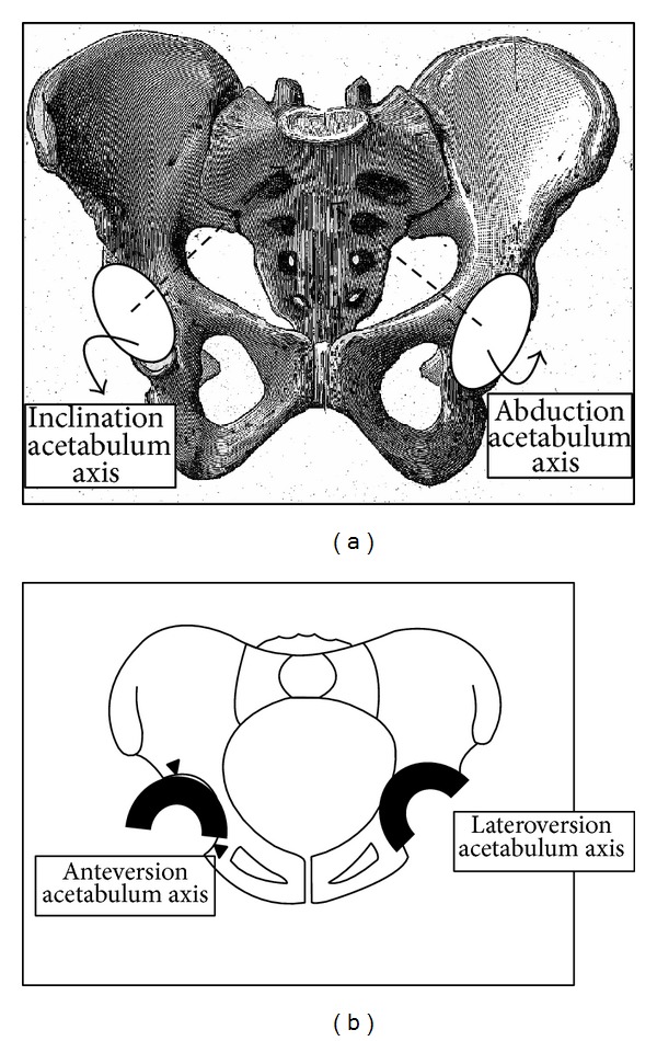 Pelvic incidence: a predictive factor for three-dimensional acetabular orientation-a preliminary study.