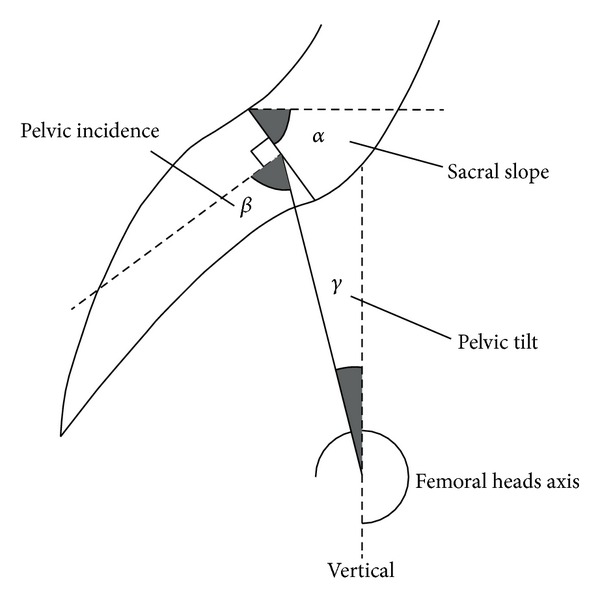 Pelvic incidence: a predictive factor for three-dimensional acetabular orientation-a preliminary study.