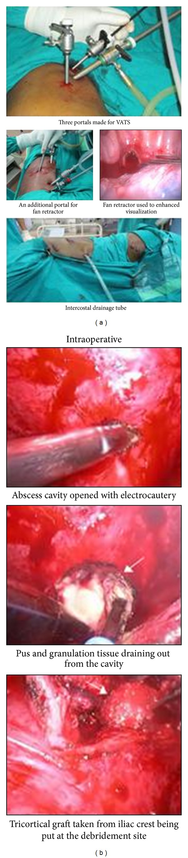 Video-assisted thoracic surgery for tubercular spondylitis.