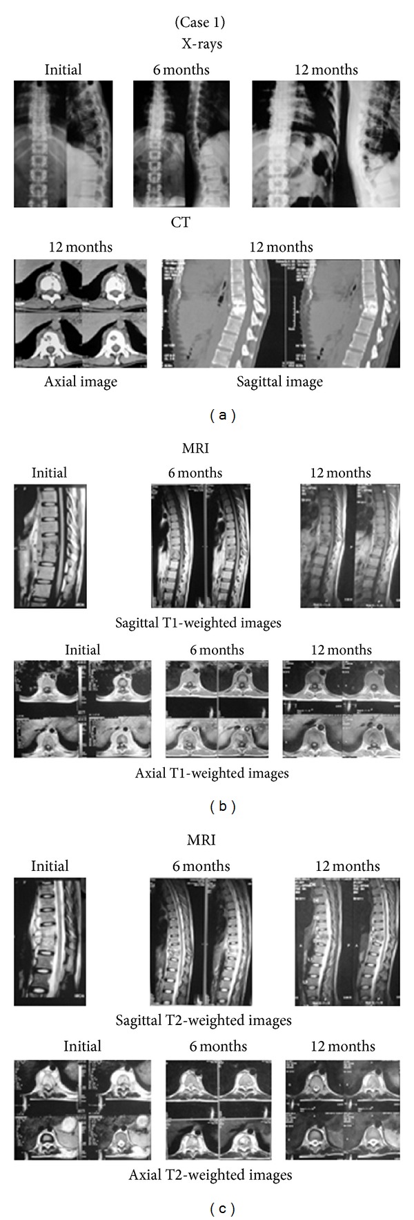 Video-assisted thoracic surgery for tubercular spondylitis.