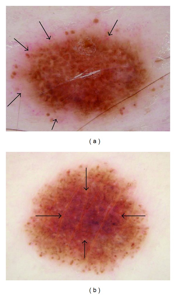 The pink rim sign: location of pink as an indicator of melanoma in dermoscopic images.