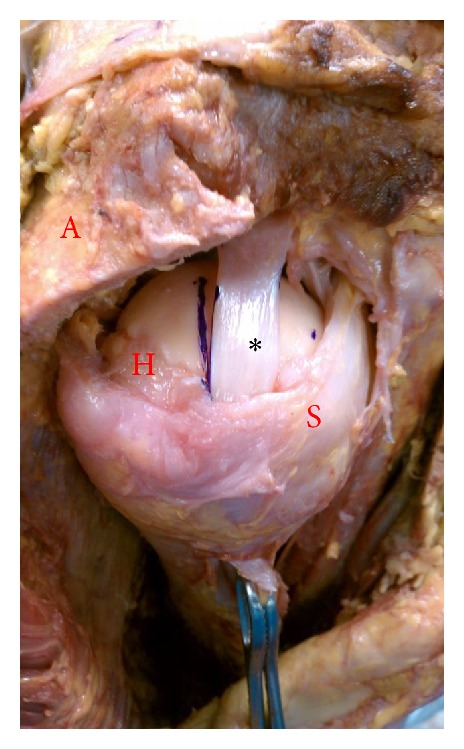Mapping the articular contact area of the long head of the biceps tendon on the humeral head.