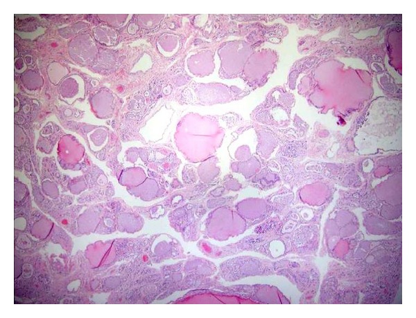 Histopathological Changes of the Thyroid and Parathyroid Glands in HIV-Infected Patients.