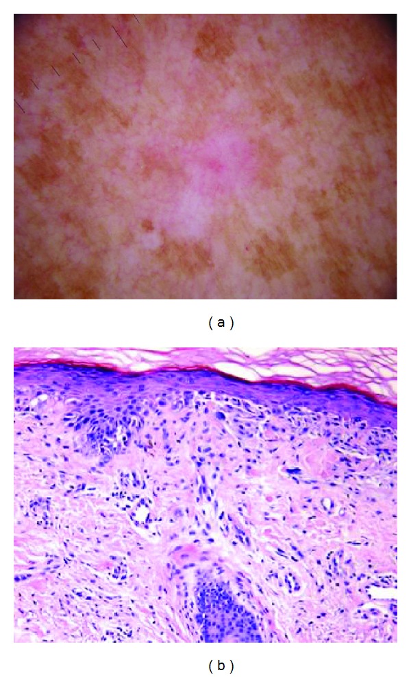 The pink rim sign: location of pink as an indicator of melanoma in dermoscopic images.