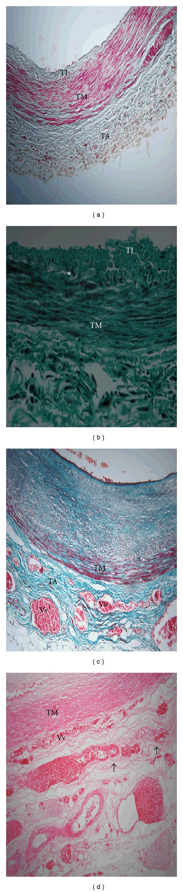 Features of atherosclerosis in the tunica adventitia of coronary and carotid arteries in a black kenyan population.
