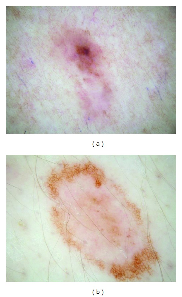 The pink rim sign: location of pink as an indicator of melanoma in dermoscopic images.