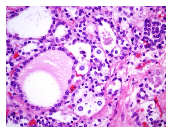 Histopathological Changes of the Thyroid and Parathyroid Glands in HIV-Infected Patients.