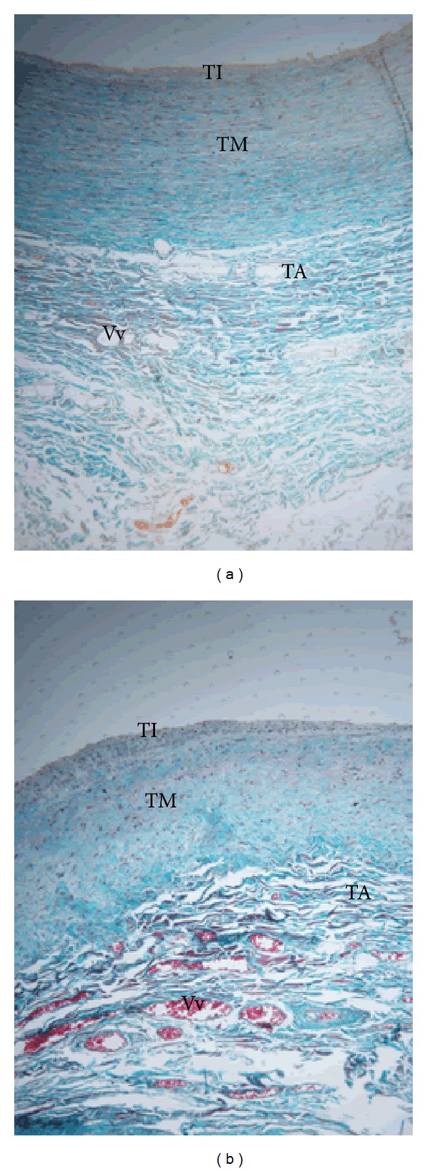 Features of atherosclerosis in the tunica adventitia of coronary and carotid arteries in a black kenyan population.