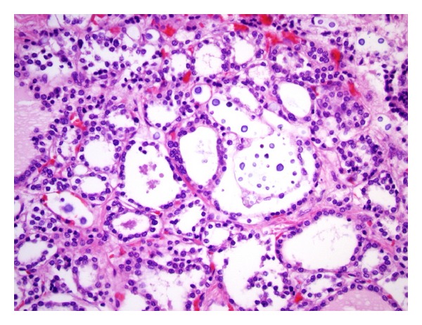 Histopathological Changes of the Thyroid and Parathyroid Glands in HIV-Infected Patients.