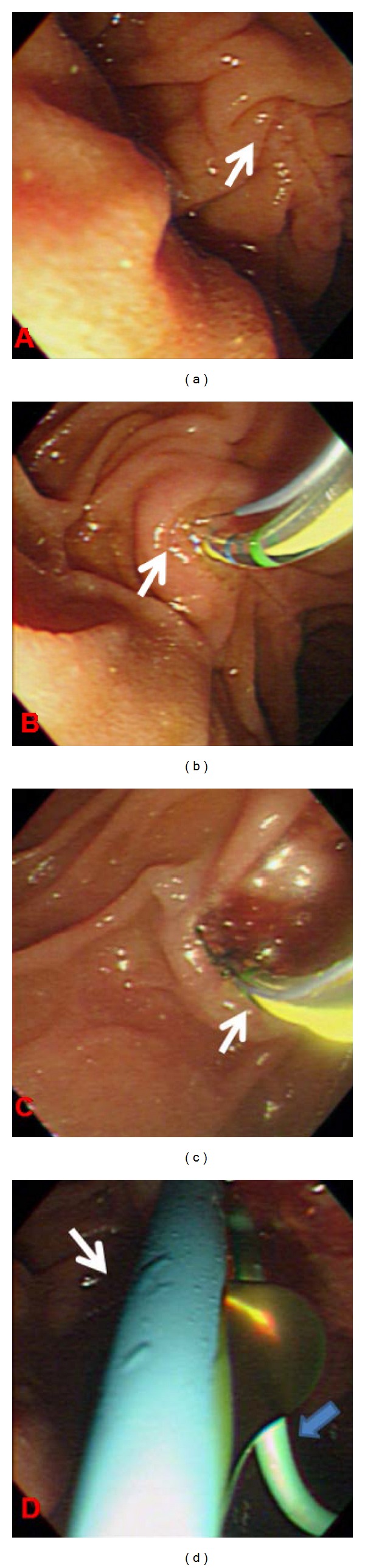 Transpancreatic precut sphincterotomy for biliary access: the relation of sphincterotomy size to immediate success rate of biliary cannulation.