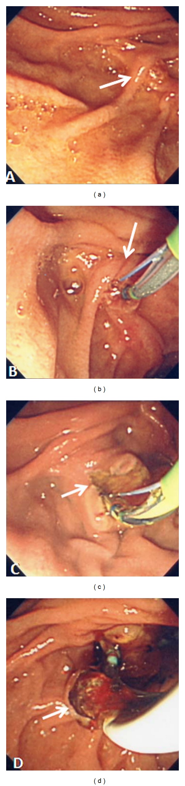 Transpancreatic precut sphincterotomy for biliary access: the relation of sphincterotomy size to immediate success rate of biliary cannulation.