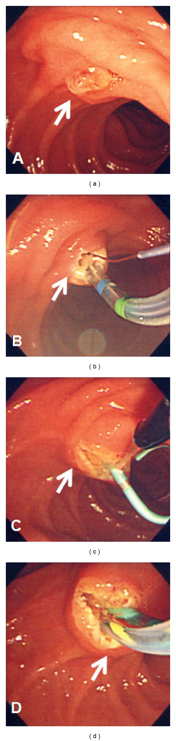 Transpancreatic precut sphincterotomy for biliary access: the relation of sphincterotomy size to immediate success rate of biliary cannulation.