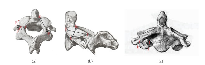 Morphometric analysis of lateral masses of axis vertebrae in north indians.