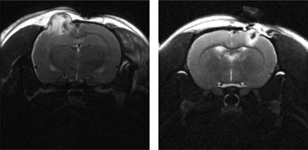 FDG-PET imaging in mild traumatic brain injury: a critical review.