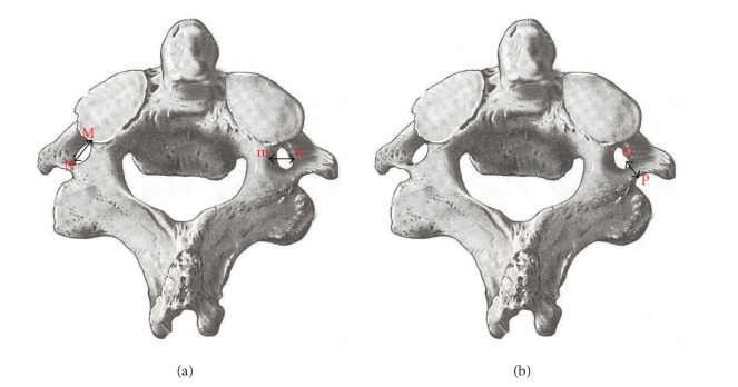 Morphometric analysis of lateral masses of axis vertebrae in north indians.