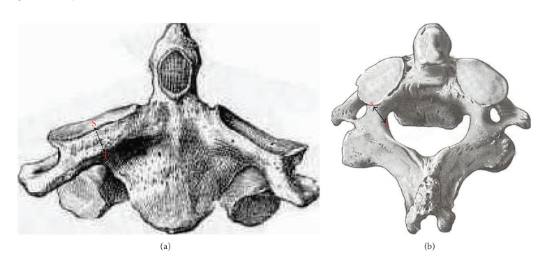 Morphometric analysis of lateral masses of axis vertebrae in north indians.