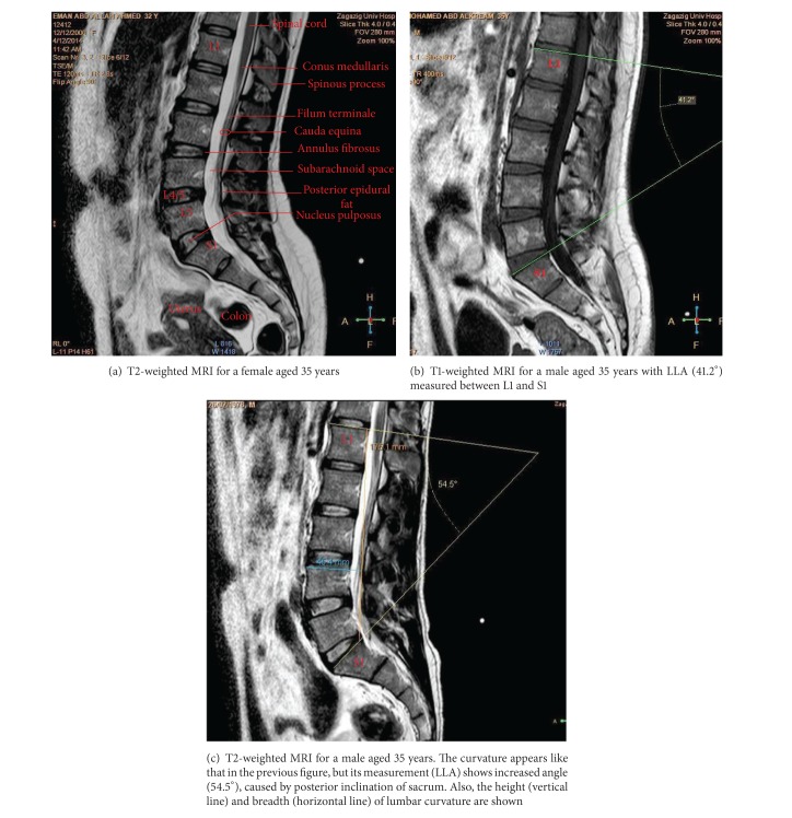 Midsagittal anatomy of lumbar lordosis in adult egyptians: MRI study.