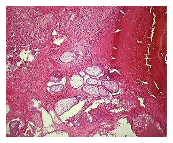 Histopathological audit of 373 nononcological hysterectomies in a teaching hospital.