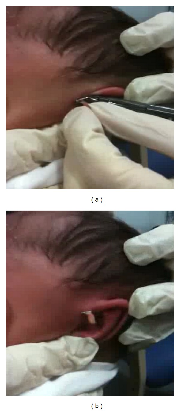 One-stop outpatient management of accessory auricle in children with titanium clip.