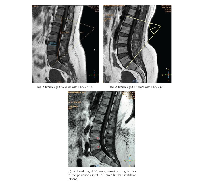 Midsagittal anatomy of lumbar lordosis in adult egyptians: MRI study.