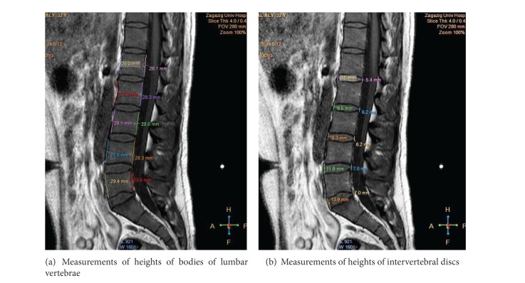 Midsagittal anatomy of lumbar lordosis in adult egyptians: MRI study.