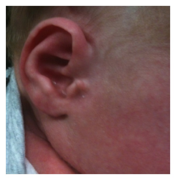 One-stop outpatient management of accessory auricle in children with titanium clip.