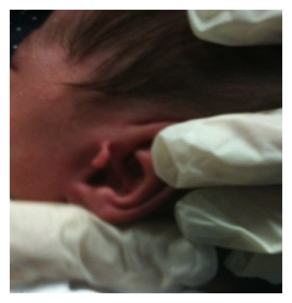 One-stop outpatient management of accessory auricle in children with titanium clip.