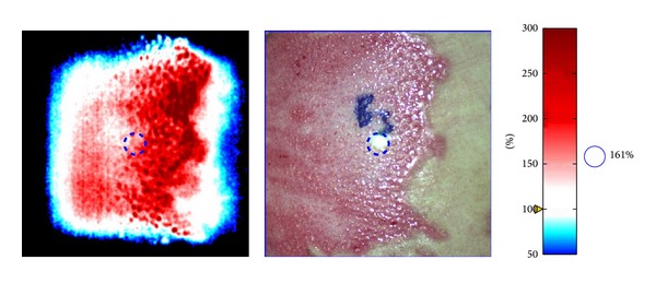 A systematic review of the evolution of laser Doppler techniques in burn depth assessment.
