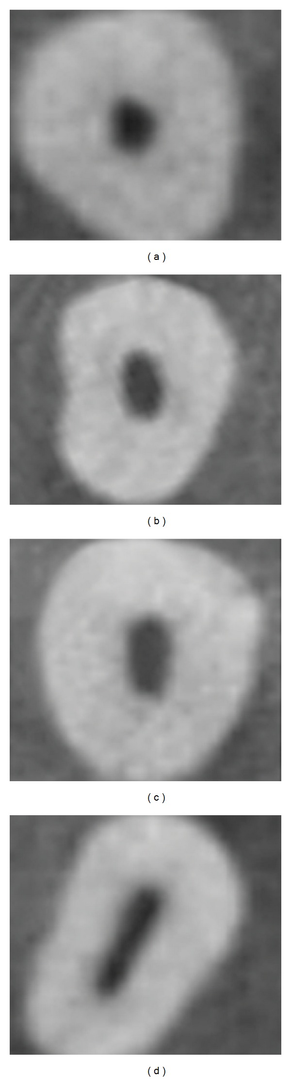 Root canal morphology of permanent maxillary and mandibular canines in Indian population using cone beam computed tomography.
