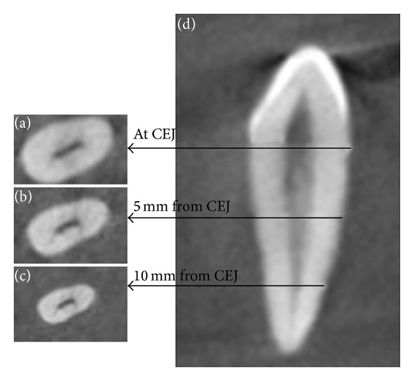 Root canal morphology of permanent maxillary and mandibular canines in Indian population using cone beam computed tomography.
