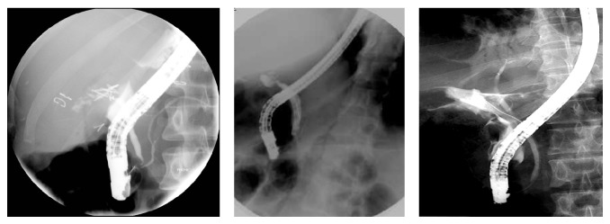 Iatrogenic biliary injuries: multidisciplinary management in a major tertiary referral center.