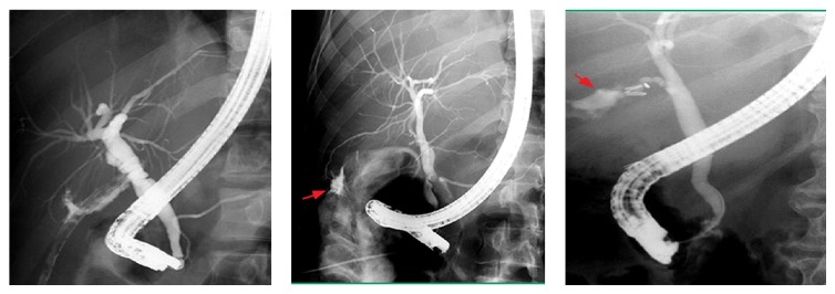 Iatrogenic biliary injuries: multidisciplinary management in a major tertiary referral center.