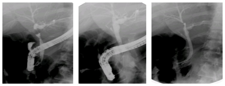 Iatrogenic biliary injuries: multidisciplinary management in a major tertiary referral center.