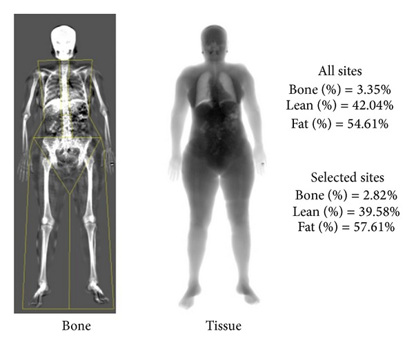 Whole body bone tissue and cardiovascular risk in rheumatoid arthritis.