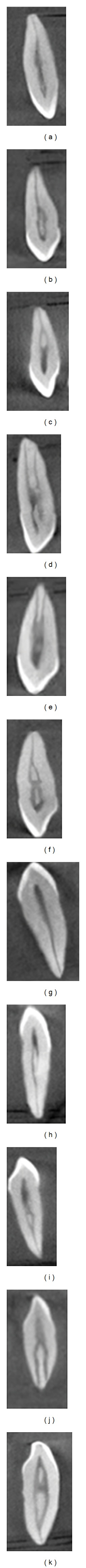 Root canal morphology of permanent maxillary and mandibular canines in Indian population using cone beam computed tomography.
