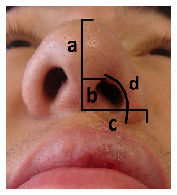 Evaluation of the use of auricular composite graft for secondary unilateral cleft lip nasal alar deformity repair.