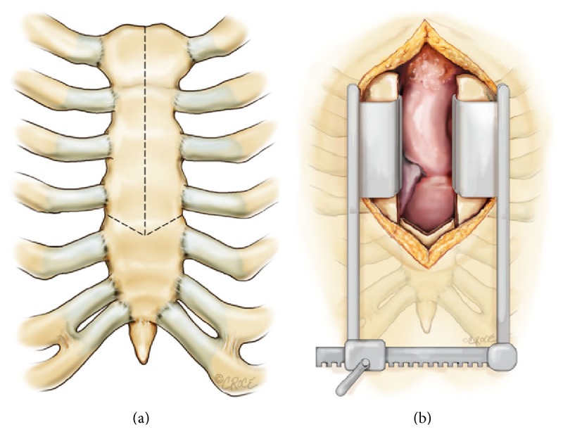 The arrowhead ministernotomy with rigid sternal plate fixation: a minimally invasive approach for surgery of the ascending aorta and aortic root.