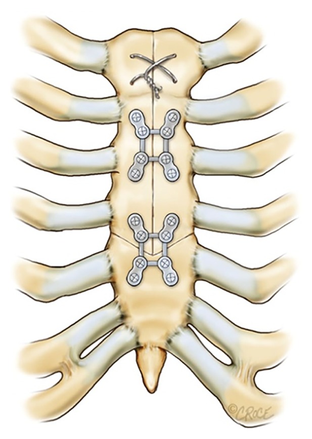 The arrowhead ministernotomy with rigid sternal plate fixation: a minimally invasive approach for surgery of the ascending aorta and aortic root.